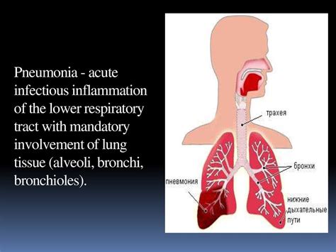 Pneumonia Currently Several Types Of Pneumonia Are Distinguished