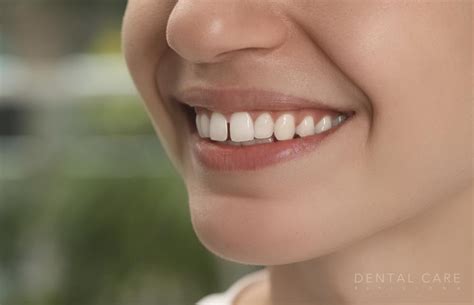 La Verdad Sobre Los Diastemas Lo Que Hay Que Saber Dental Care Barcelona