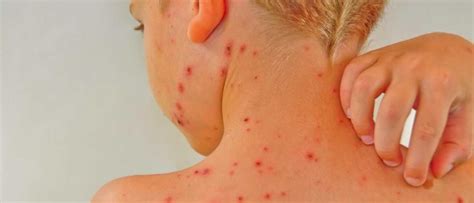 Is It True You Can Only Catch Chicken Pox Once Bbc Science Focus