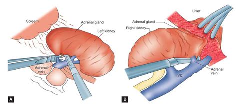 Left Laparoscopic Adrenalectomy