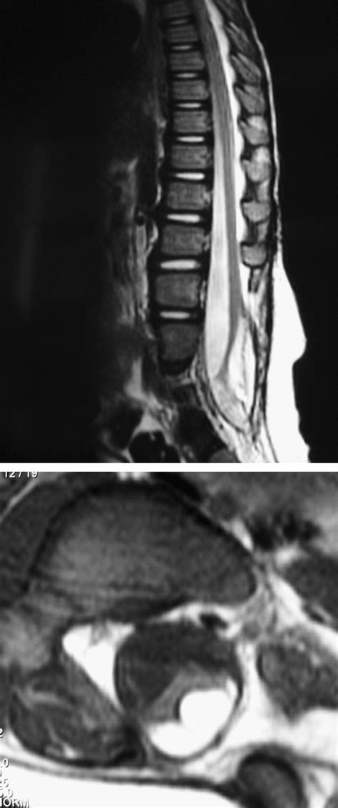 Outcome Of Untethering For Symptomatic Spina Bifida Occulta With