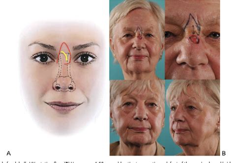Figure 2 From One Stage Nasal Soft Tissue Reconstruction With Local