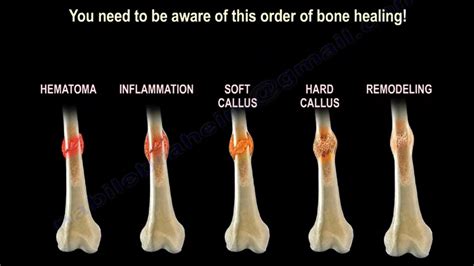 How Does Damaged Bone Heal Reinforcevitality Com