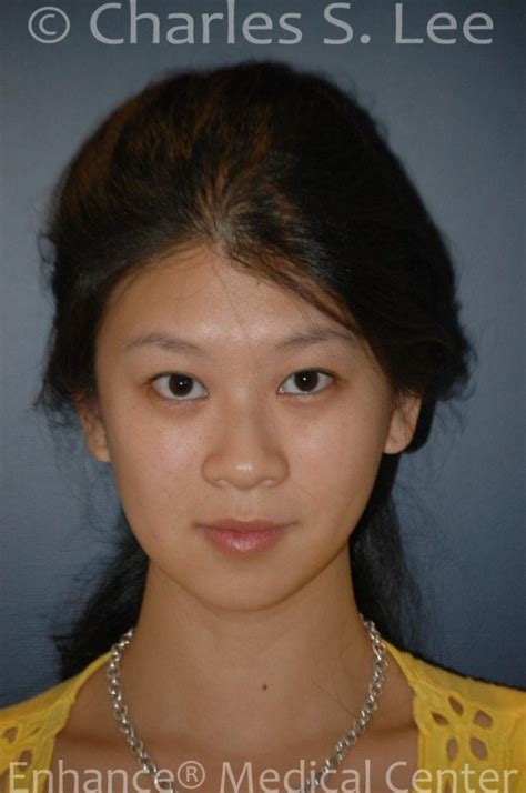 Asian Eyelid Surgery Medical Article Translated Charles S Lee Md