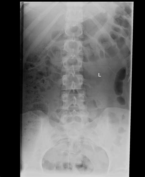 One can look at the health of the discs, facets, nerve root foramen, alignment, look for pars defects (spondylolisthesis) and scoliosis. BACKBONE 2 | buyxraysonline