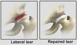 Photos of Labral Tear Shoulder Treatment Options