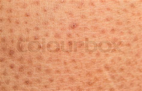 Closeup Of Skin Problemdry Skin Ichthyosis Vulgaris Stock Image