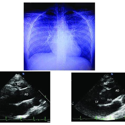 Figure1 Chest X Ray Shows Normal Cardiac Area And Pulmonary Vascular