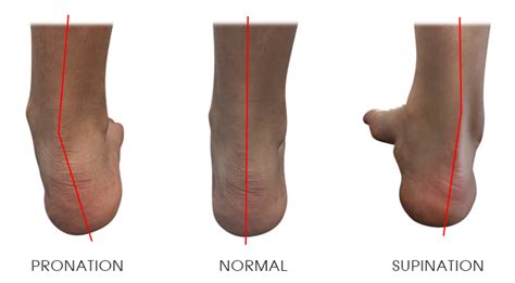 Supination Foot Biomechanics Explained Types Causes Treatment Vlr