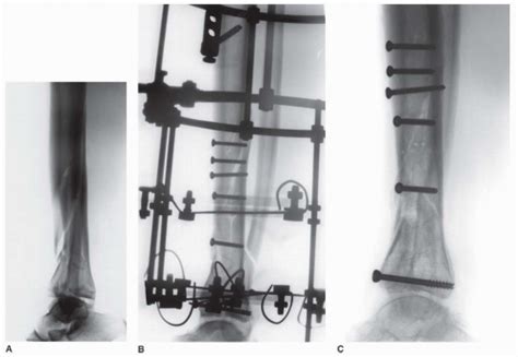 Tibial Pilon Fractures Tensioned Wire Circular Fixation