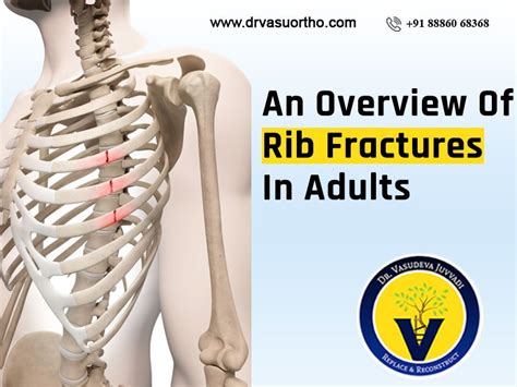 An Overview Of Rib Fractures In Adults Vasudeva