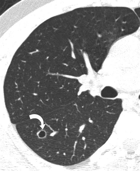 Pulmonary Cryptococcosis In Immunocompetent Patients Ct Findings In 12