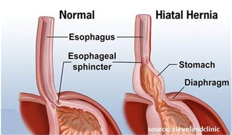 Hiatal Hernia And How It Causes Acid Reflux
