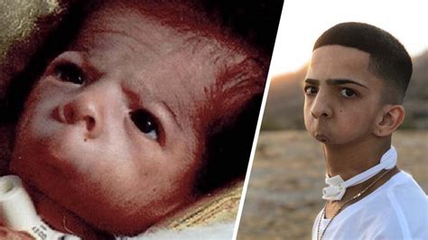 A Baby Boy Born Without A Jaw The Outcome 20 Years Later Is
