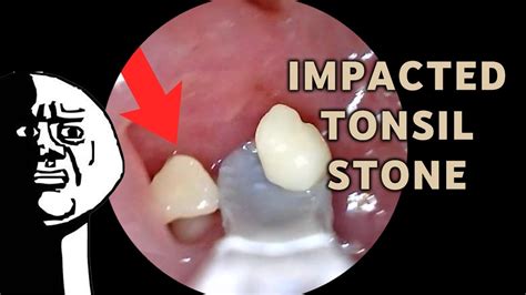 Impacted Tonsil Stone Removal Aim 21 Youtube