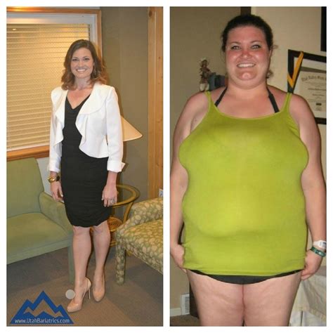 Years After Weight Loss Surgery Transfermanager