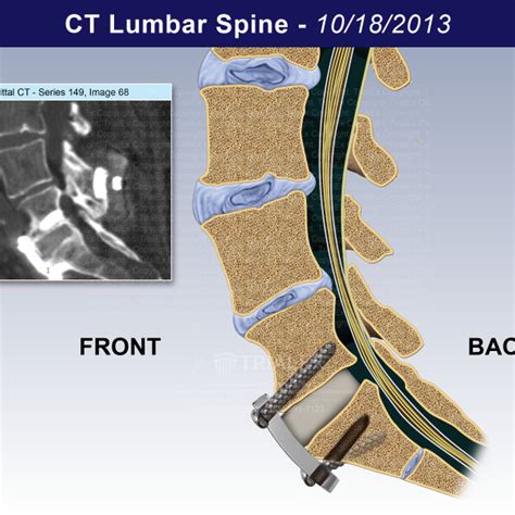 Ct Lumbar Spine Trialexhibits Inc