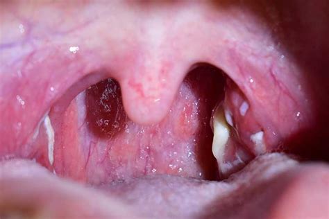 Tonsillectomy In Children When Is It Necessary Ausmed