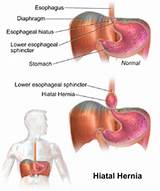 Photos of Hiatal Hernia Diagnosis And Treatment