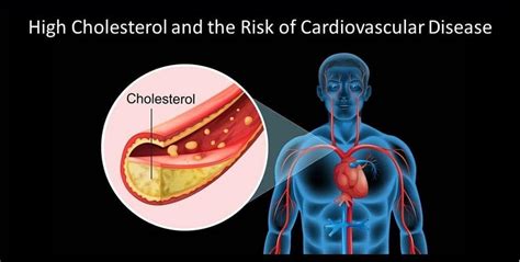 Cardiovascular Disease High Cholesterol - Cardiovascular Disease