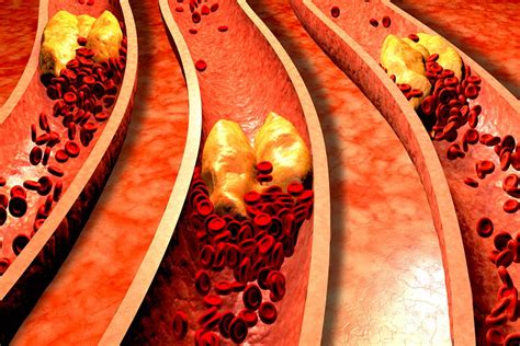Clogging of arteries in the neck can result in lack of blood supply to the brain. Is it possible to unclog your arteries? - Holistic Living Tips
