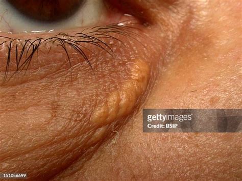 Plaque Of Xanthelasma Photos And Premium High Res Pictures Getty Images