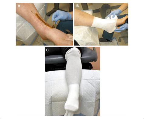 A The Anterior Ankle Incision Is First Sterilized With Betadine Swab