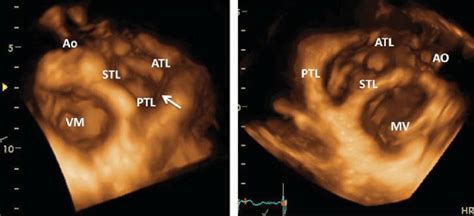 Normal Tricuspid Valve Leaflets Visualized By Real Time Download
