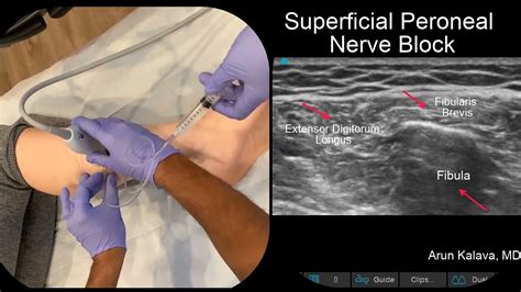 Superficial Peroneal Nerve Block Ultrasound Guided Youtube