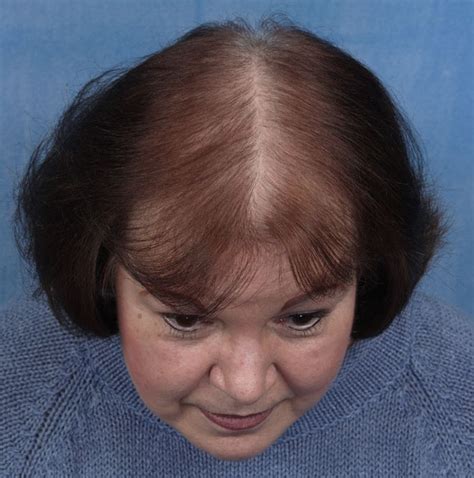 1000+ images about Female Pattern Baldness on Pinterest ...