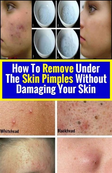 How To Remove Pimples From Your Skin Without Damaging It Pimples