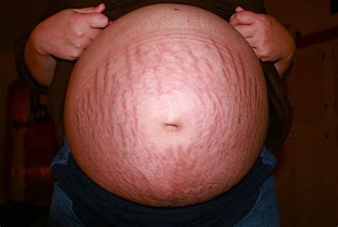 Stretch Marks Types Causes And Treatment Wrinkles Center
