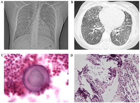 Diagnostic Imaging And Pathological Features Of Case 1 A A Chest