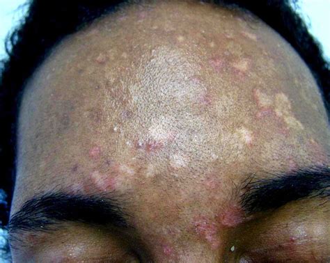 White Spots Skin Problem You Should Know Healthy Web Md
