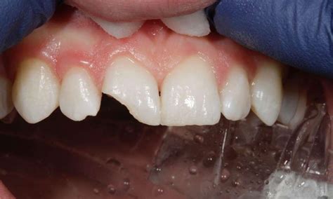 Bonding To Repair A Chipped Front Tooth Rogers Ar