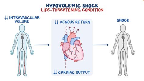Hypovolemic Shock Clinical Sciences Osmosis Video Library