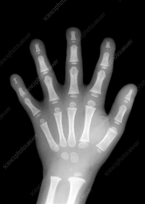 Hand Bones Anatomy