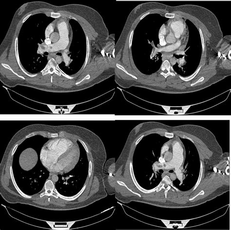 Pulmonary Ct Angiography Demonstrates Bilateral Pulmonary Thromboemboli