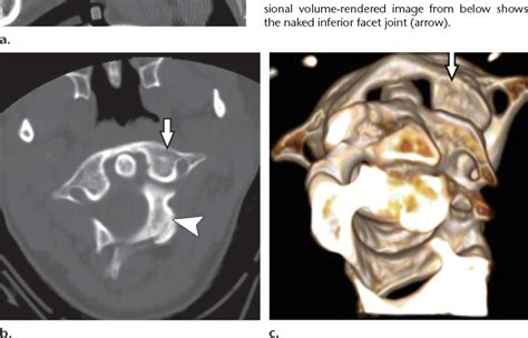 Figure 21 From Imaging Of Atlanto Occipital And Atlantoaxial Traumatic