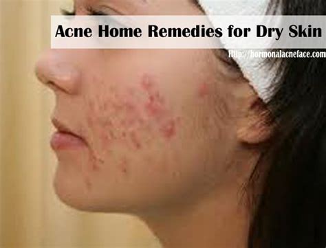 Acne Home Remedies For Dry Skin Acne Home Remedies For Dry Skin