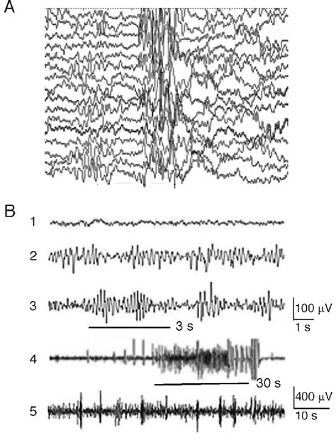 Dravet Syndrome A Interictal Scalp Eeg Recording In A Male Patient