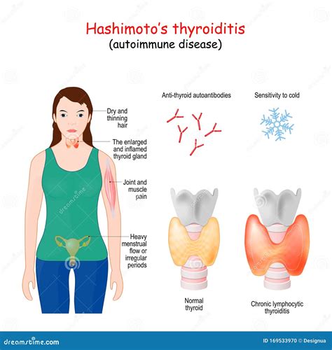 Thyroidgland Clipart And Illustrations