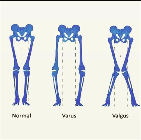 Varus Vs Valgus Fracture