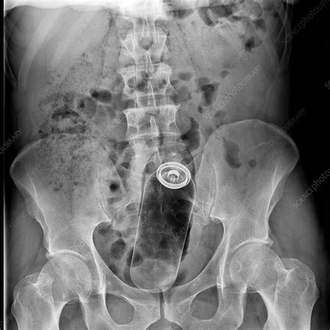 Foreign Body In Rectum X Ray Stock Image C0386646 Science Photo