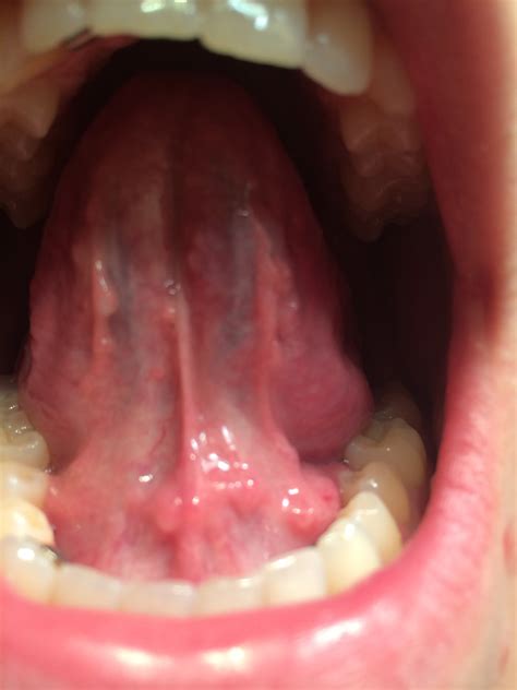 Painful Bumps On Lingual Frenulum Hurts I Have Red Sores On My Tongue The Best Porn Website