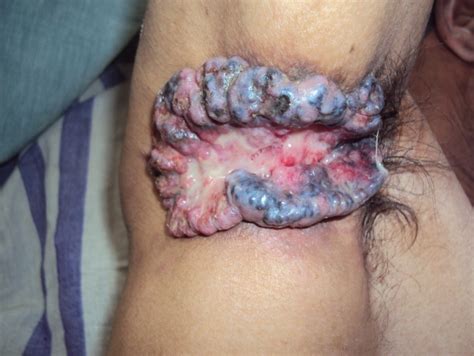 Basal Cell Carcinoma Of The Right Axilla In A 35 Year Old Indian Male
