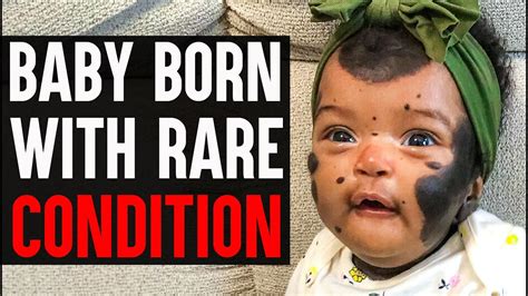 Baby Girl Born With Rare Condition The Way It Changed Her Life Is