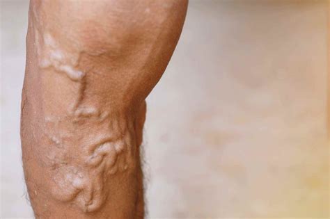 Varicose Veins Symptoms And Treatment Vein Clinic Perth