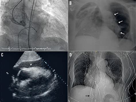 Transcatheter Aortic Valve Implantation The Importance Of An