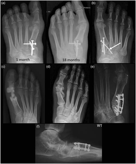 Clinical And Imaging Assessment And Treatment Of Hallux Valgus Nathan